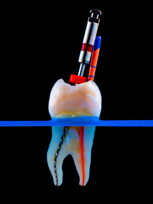 The Root Canal Foundation in Chennai