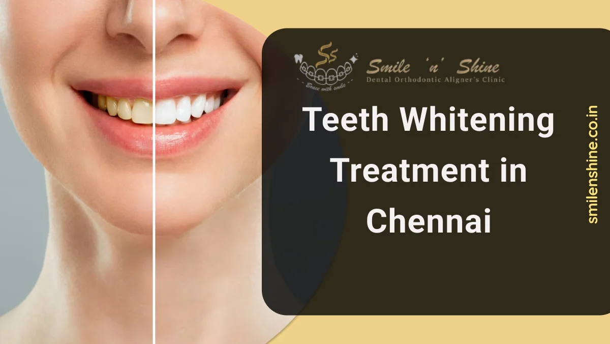 Teeth Whitening Treatment in Chennai