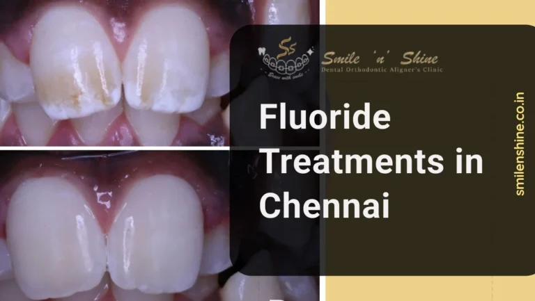 fluoride treatments in chennai