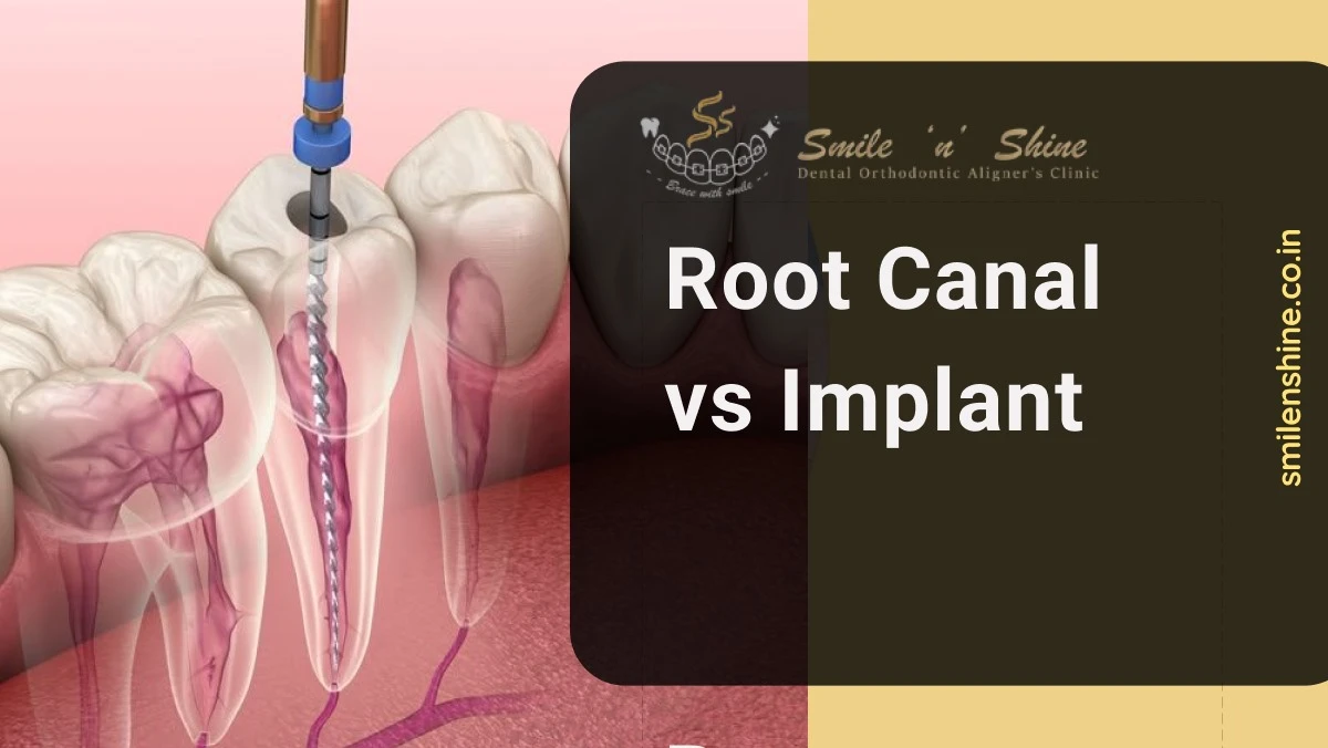 Root Canal vs Implant