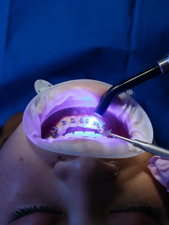 Root Canal or Implant – Which is Better?