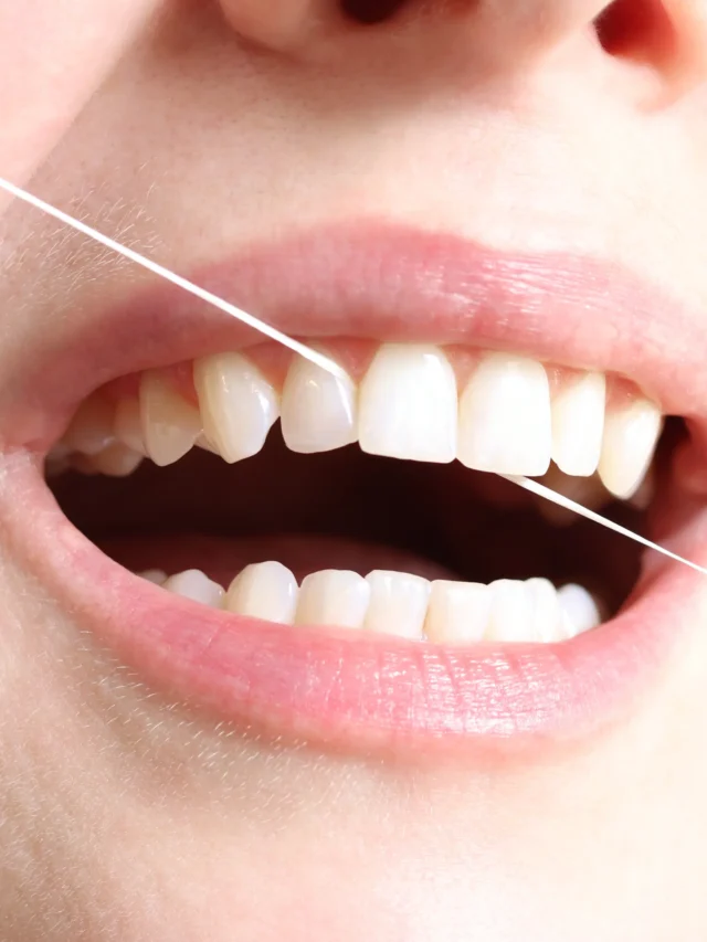 Teeth Cleaning in Chennai